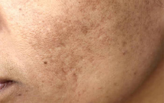 skin pigmentation