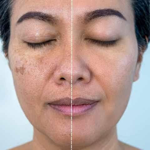 Best Treatments for Skin Pigmentation