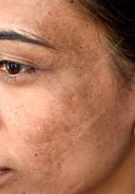 What Is Melasma